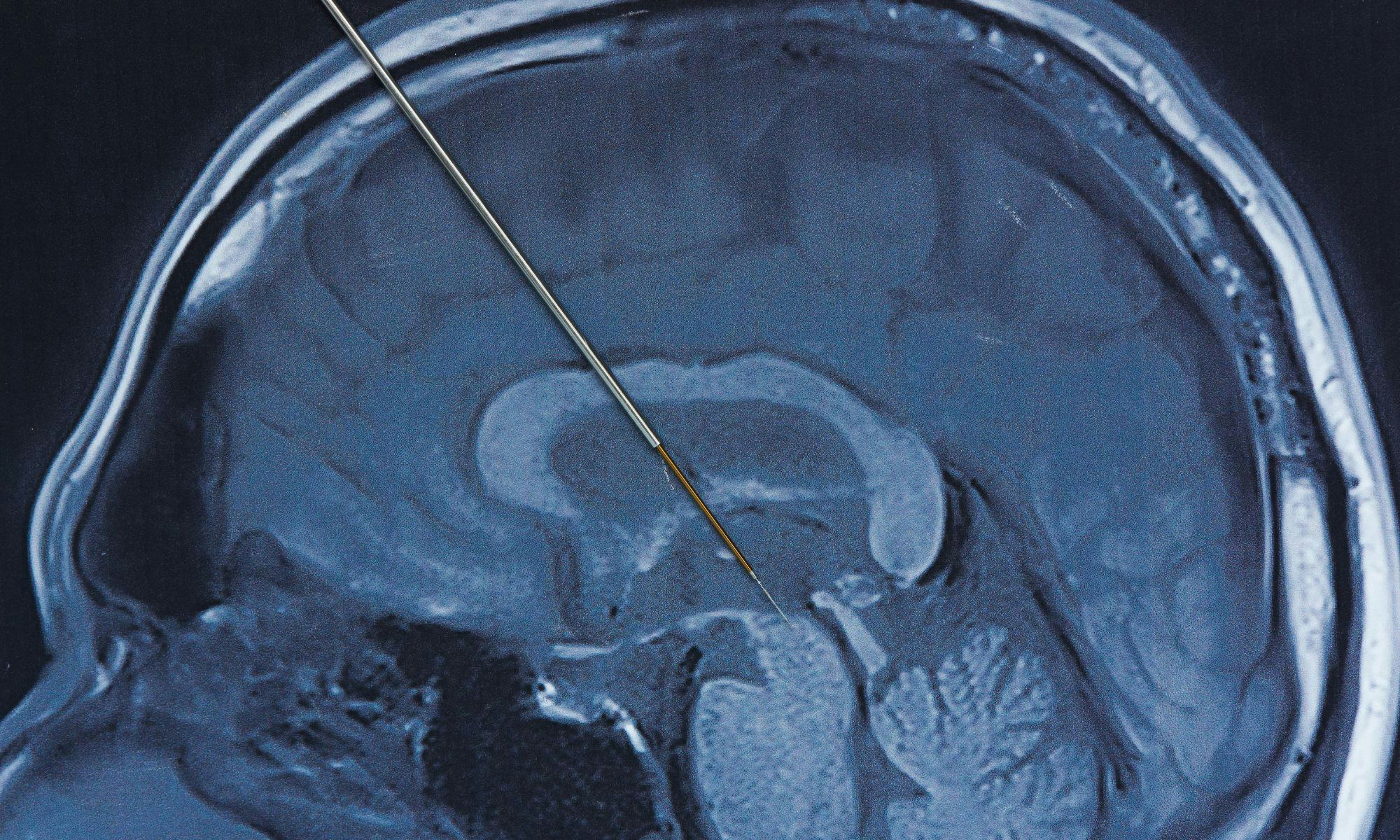 Überwindung von Zwängen: Eine persönliche Erfahrung mit tiefer Hirnstimulation